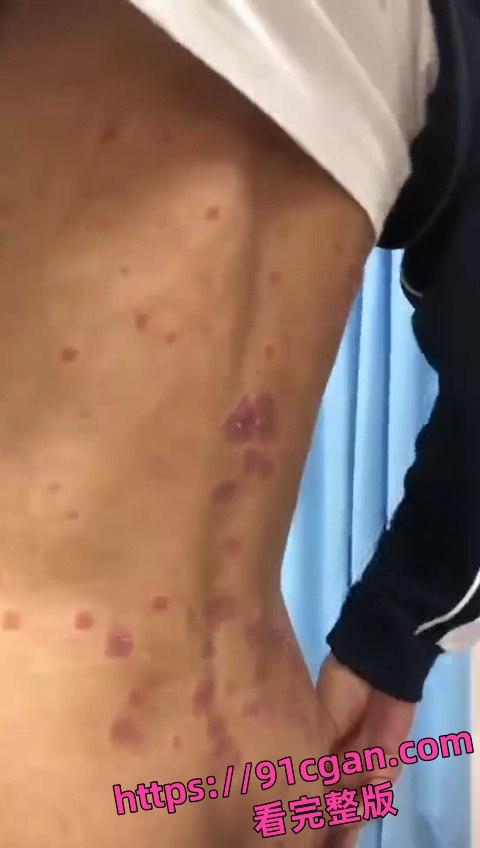 初三男生 年纪轻轻就集齐梅毒和艾滋于一身！这症状都3期了吧 还死不承认！-2